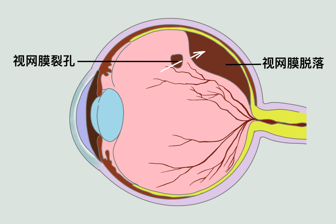 视网膜脱落的诱因,视网膜复位手术