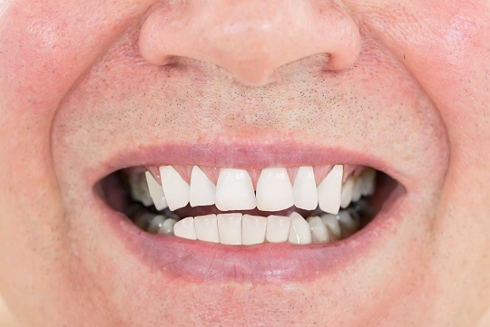 长期缺牙、假牙不合适，都可引发炎症