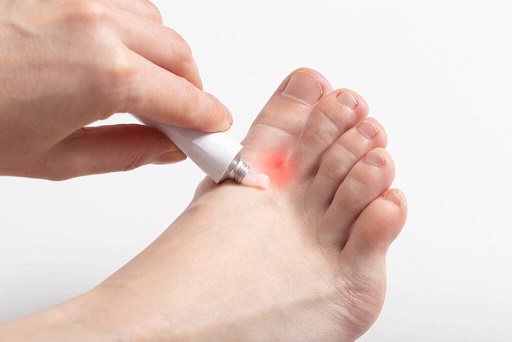 足癣是由皮肤癣菌引起的浅表真菌感染,足部感染了一种专门吃皮肤的真菌