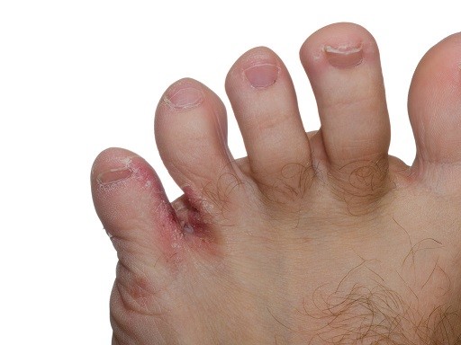 “脚气”在身体的不同部位之间也可以传染,不建议自行购药治疗