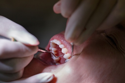 炎症因子使胰岛素的敏感性降低,牙周治疗