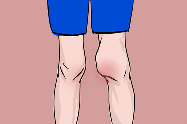 血友病;世界血友病日;玻璃人;健康;血友病患者