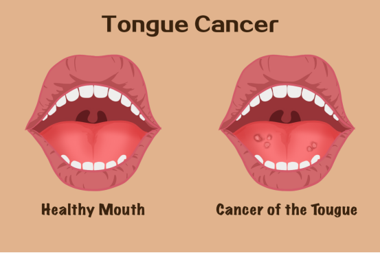 什么是舌癌,为什么很常见的口腔溃疡却会发展为舌癌,舌癌的病因有哪些
