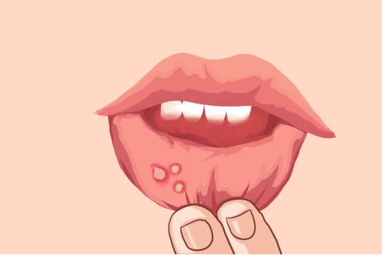 舌癌发病率高吗,舌癌的病因有哪些