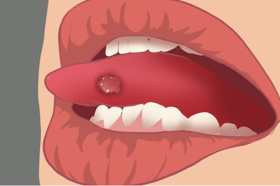 什么是舌癌,为什么很常见的口腔溃疡却会发展为舌癌,舌癌的病因有哪些