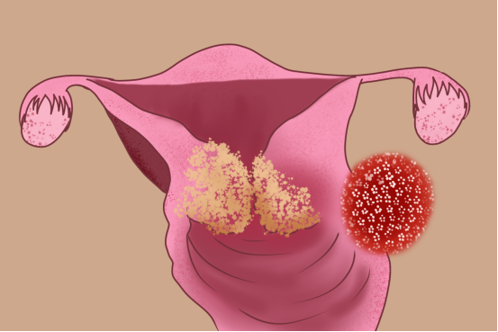 人乳头瘤病毒,什么是人乳头瘤病毒,HPV
