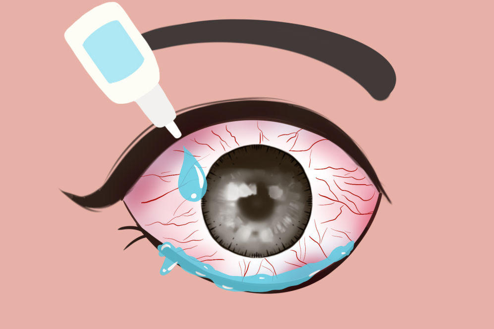 全球性眼表疾病,什么是干眼症,干眼症