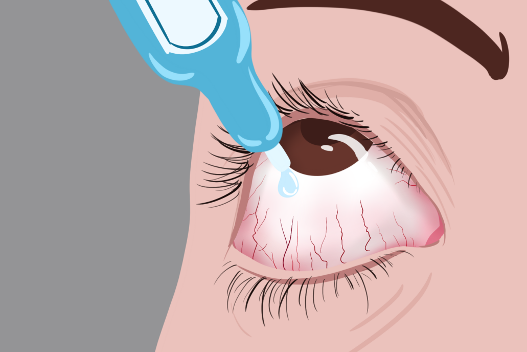 干眼症应如何治疗,干眼症应如何缓解 干眼症应如何治疗,干眼症应如何缓解