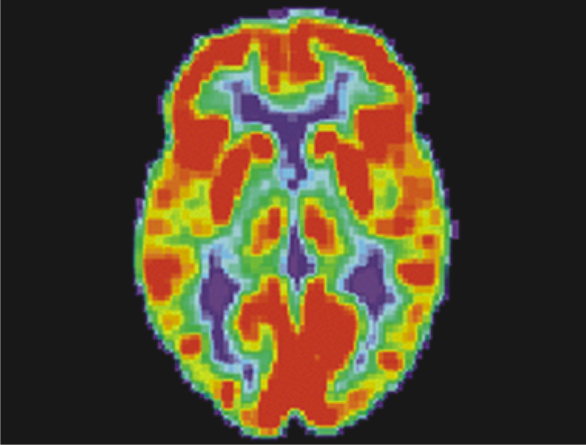 PET扫描下的大脑