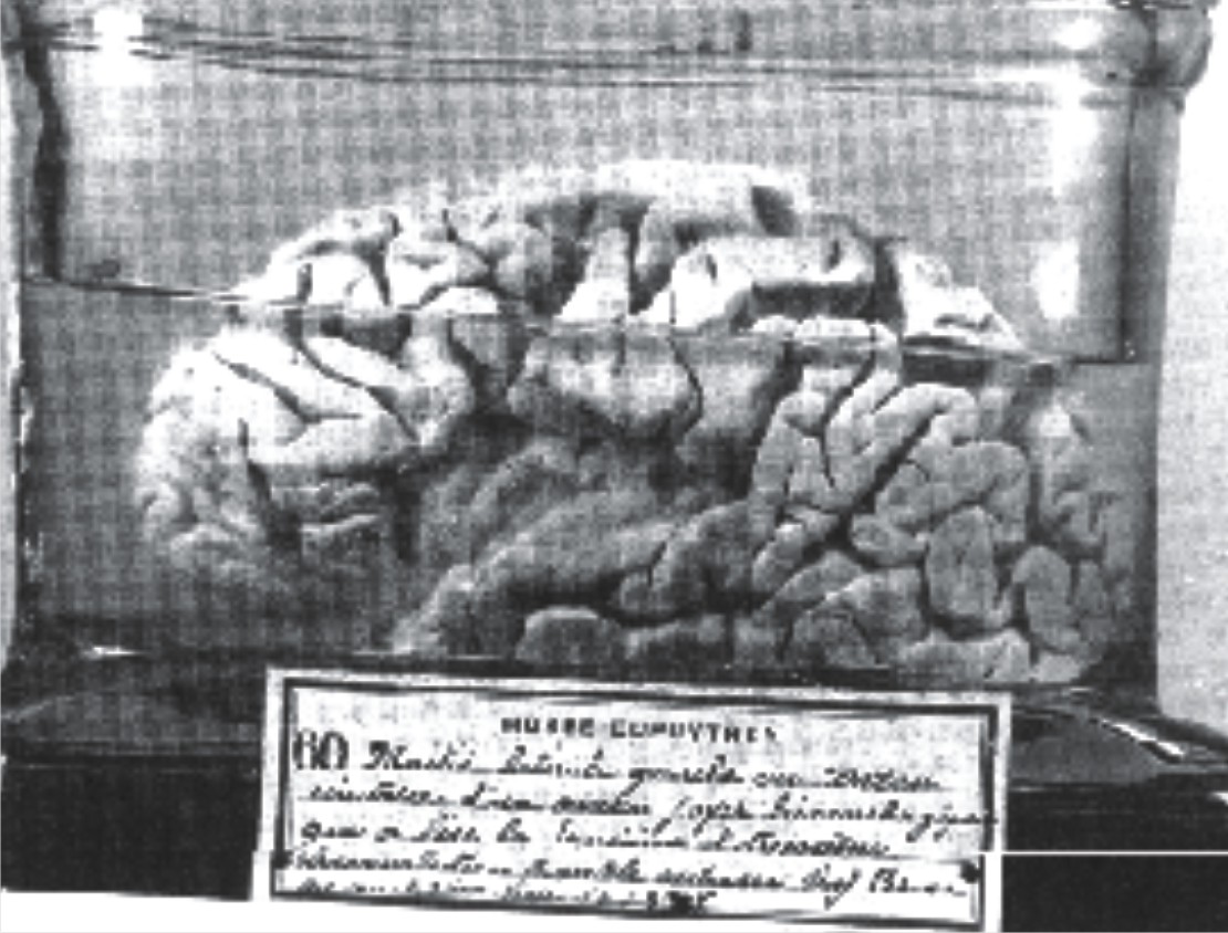 保罗·布洛卡研究用的大脑