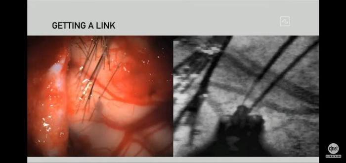 Neuralink的机器人把电极线插入活体大脑