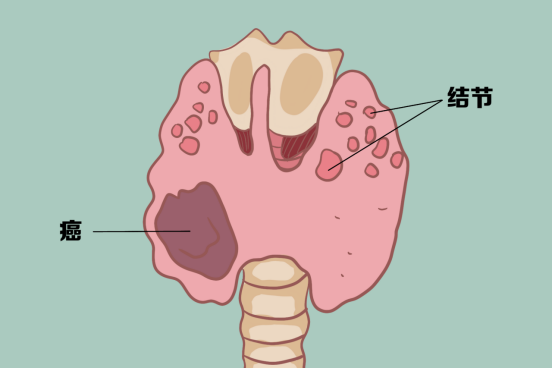 甲状腺结节如何分期,哪类结节易发生癌变