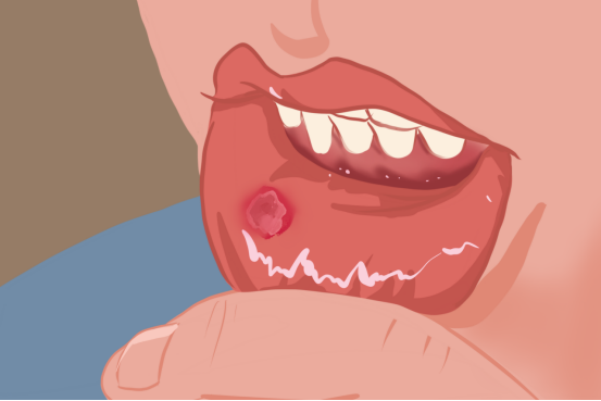 如何早期识别舌癌