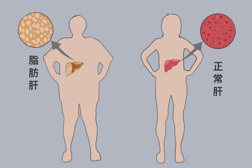 非病毒性肝炎,肝炎是一种什么疾病